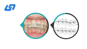 Orthodontic Niti Color Arch Wire
